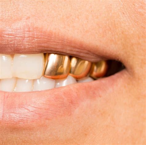 Permanent Gold Teeth In Houston Tx